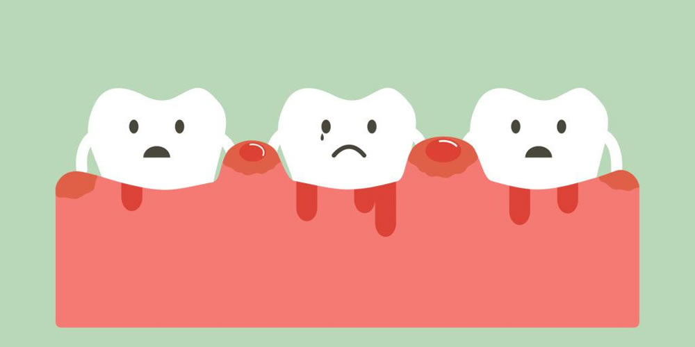 歯周病になりやすい人・悪化しやすい人の特徴について