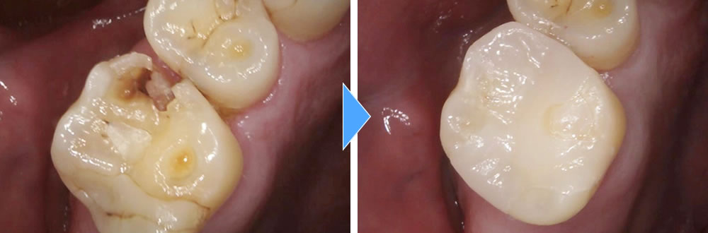 虫歯 穴 が 空い た