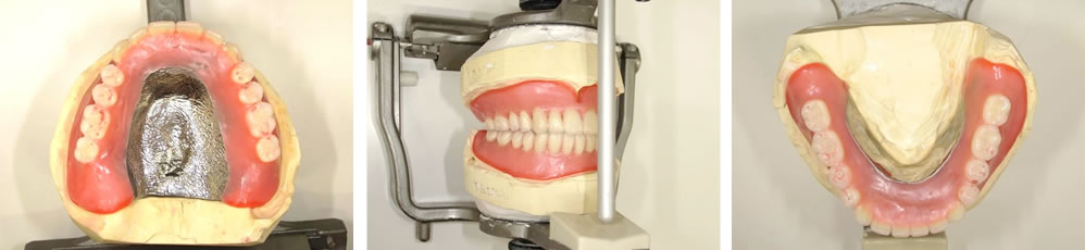 金属床デンチャーによる入れ歯治療
