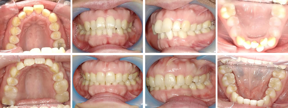 マウスピース矯正（インビザライン）の症例