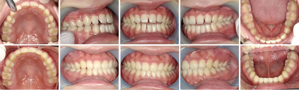 マウスピース矯正（インビザライン）の症例
