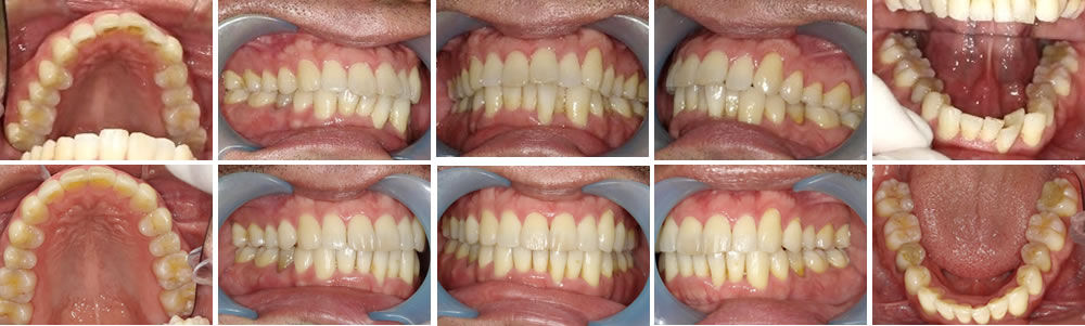 マウスピース矯正（インビザライン）の症例