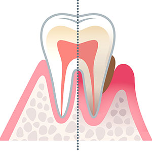 歯周病