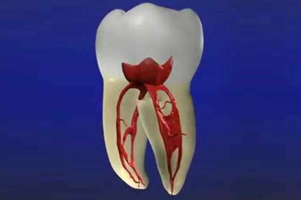 虫歯治療・根管治療