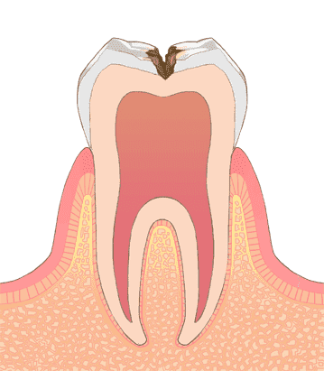 C2：自覚症状が現れる、象牙質への進行