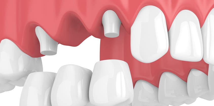 「健康な歯を削る」という、最大のデメリット