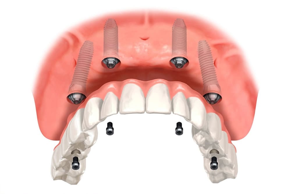 すべての歯を失ってしまった方へ：All-on-4／All-on-6
