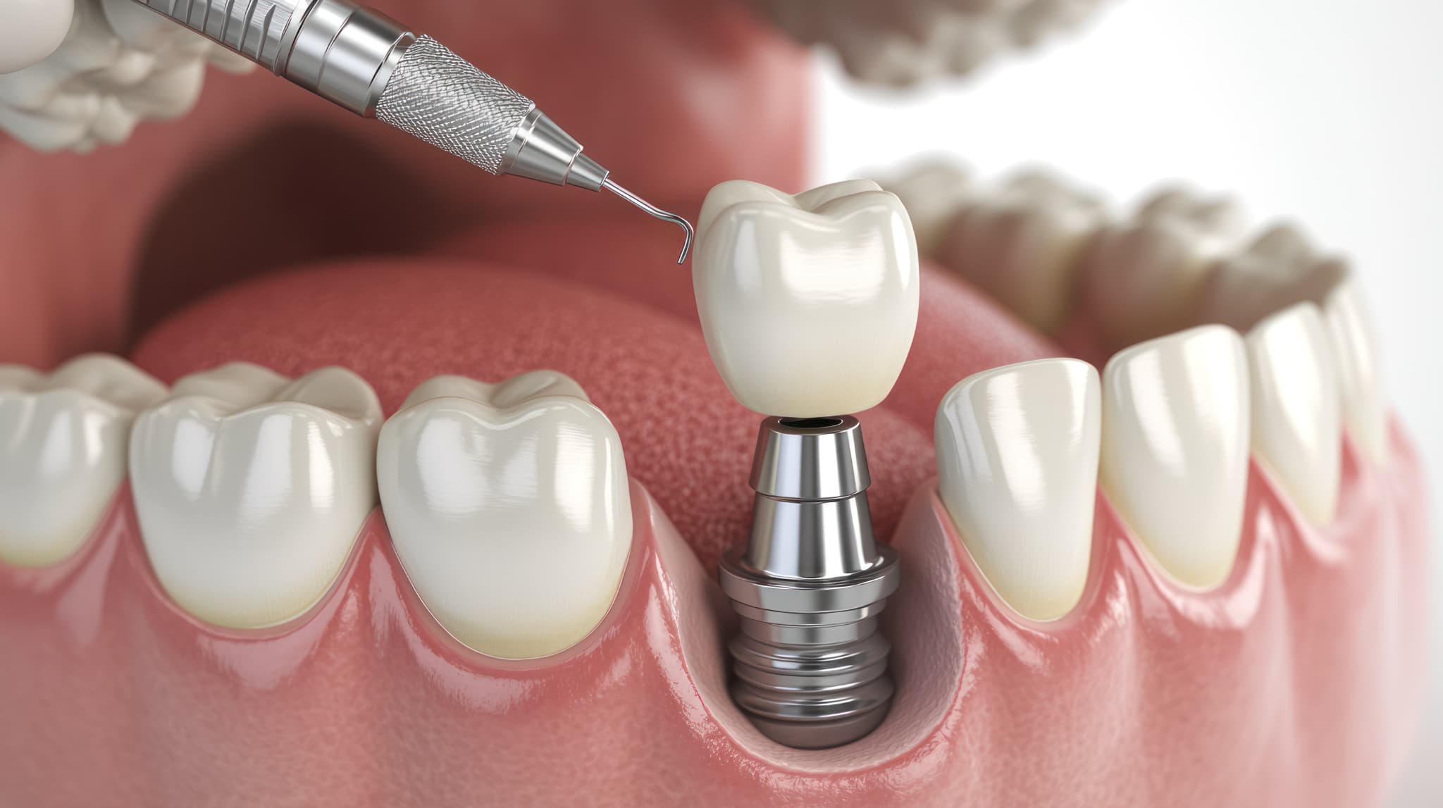 インプラント治療のイメージ